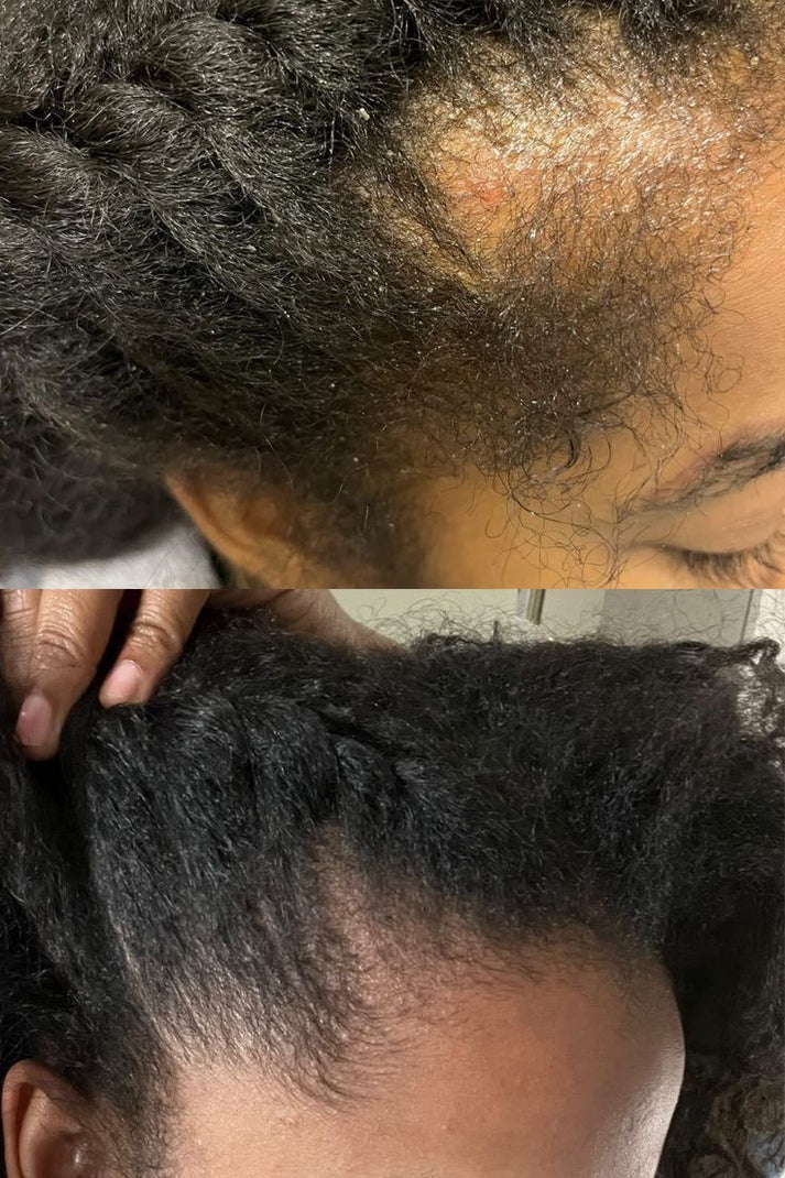 Pommade Batane pour l'Alopecie : Traitement Efficace contre la Chute et Croissance Rapide des Cheveux