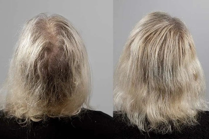 Pommade Batane pour l'Alopecie : Traitement Efficace contre la Chute et Croissance Rapide des Cheveux