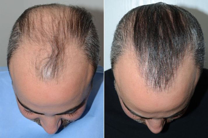 Pommade Batane pour l'Alopecie : Traitement Efficace contre la Chute et Croissance Rapide des Cheveux