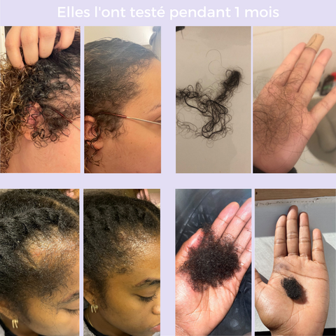 Pommade Batane pour l'Alopecie : Traitement Efficace contre la Chute et Croissance Rapide des Cheveux