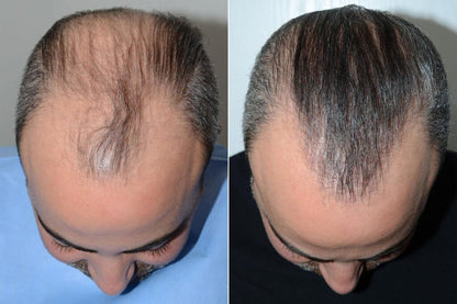 Pommade Batane pour l'Alopecie : Traitement Efficace contre la Chute et Croissance Rapide des Cheveux